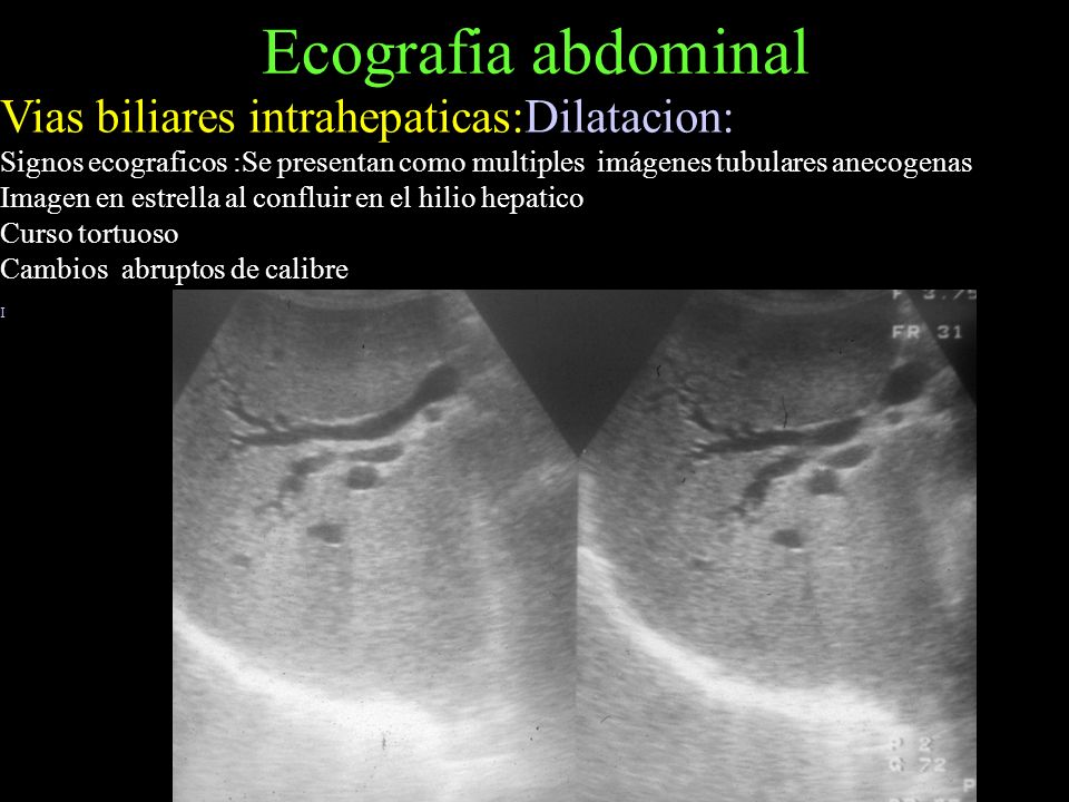 agenesia de los conductos biliares